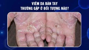 Viêm da bàn tay