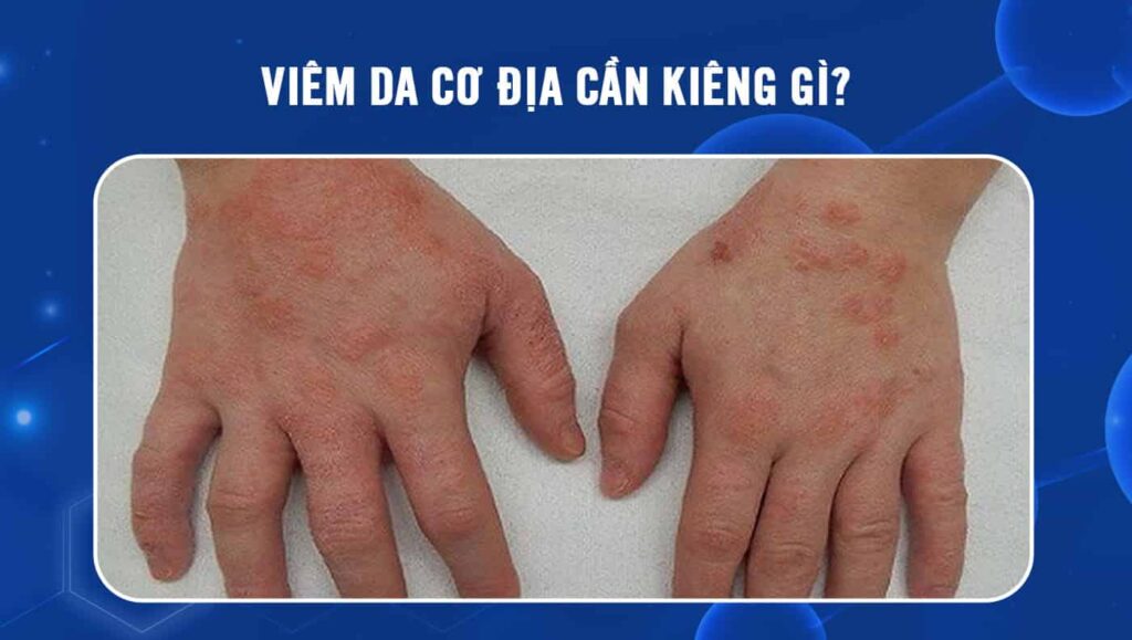 viêm da cơ địa cần kiêng gì