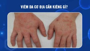 viêm da cơ địa cần kiêng gì