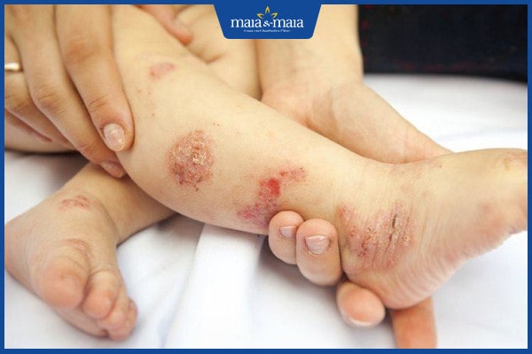 Viêm da cơ địa có ăn được thịt vịt không