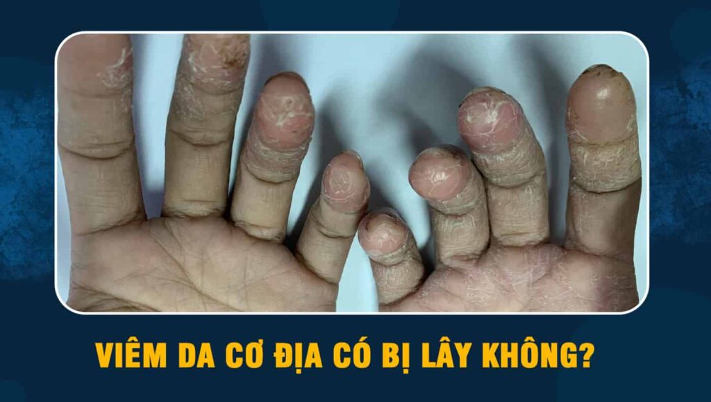 viêm da cơ địa có bị lây không