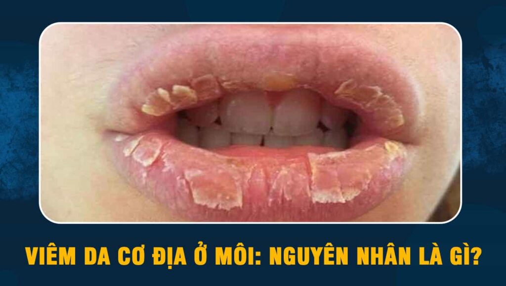 Viêm da cơ địa ở môi