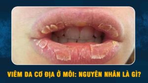 Viêm da cơ địa ở môi