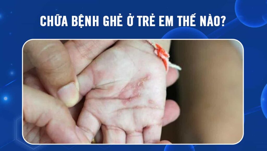 chữa bệnh ghẻ ở trẻ em