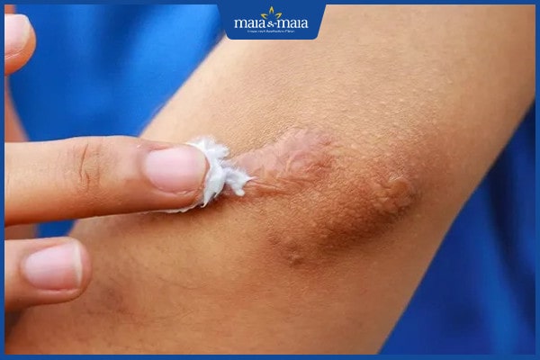 khi nào thì dùng thuốc chống sẹo