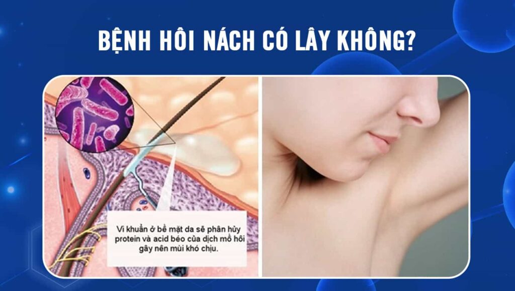 bệnh hôi nách có lây không