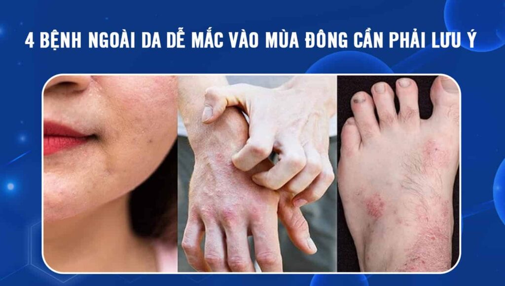 bệnh ngoài da dễ mắc vào mùa đông
