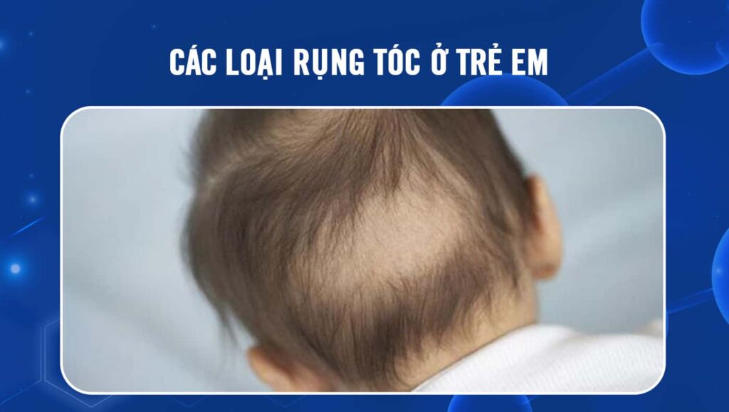 Các loại rụng tóc ở trẻ em