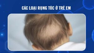Các loại rụng tóc ở trẻ em