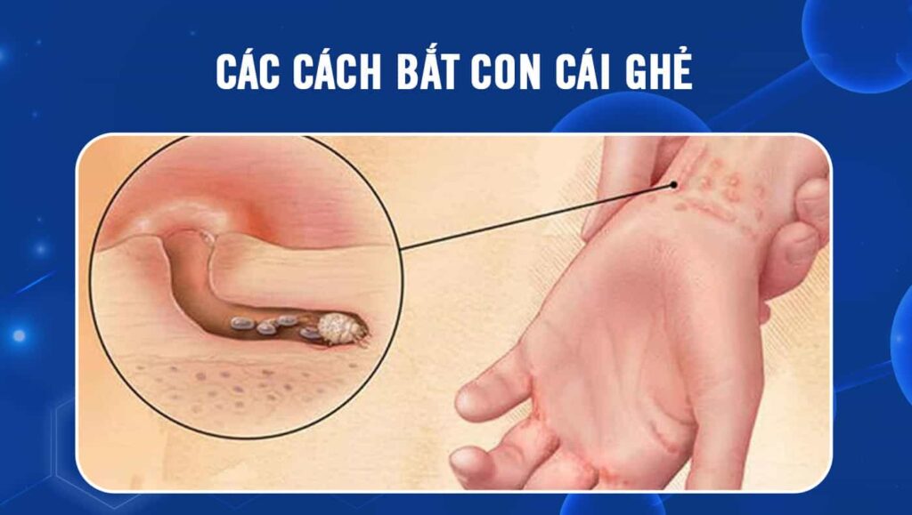 cách bắt con cái ghẻ