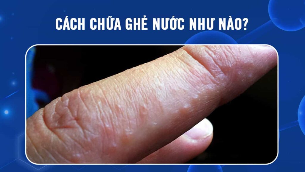 cách chữa ghẻ nước như nào