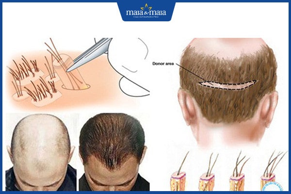 cách nào chữa rụng tóc