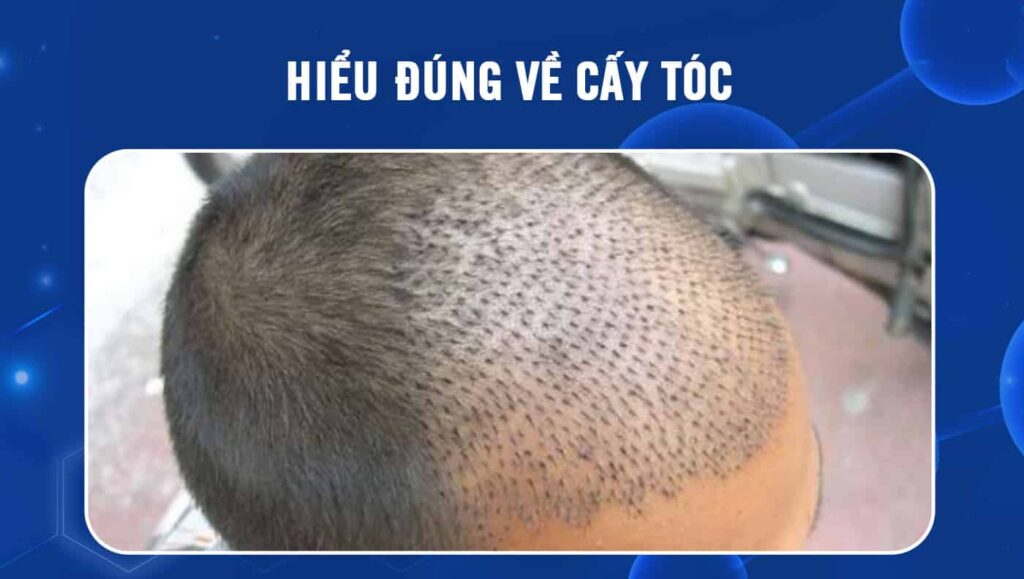 Cấy tóc