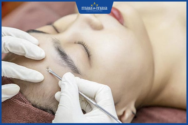 Có nên đi spa trị mụn tuổi dậy thì