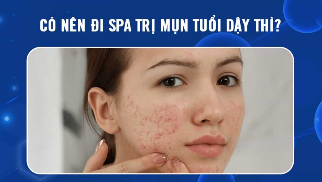 Có nên đi spa trị mụn tuổi dậy thì