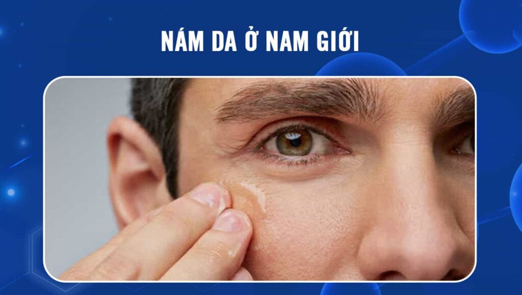 Nám da ở nam giới