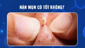 nặn mụn có tốt không