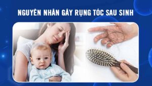 Nguyên nhân gây rụng tóc sau sinh
