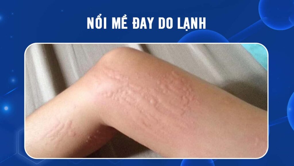 nổi mề đay do lạnh