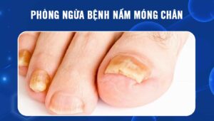 phòng ngừa bệnh nấm móng chân