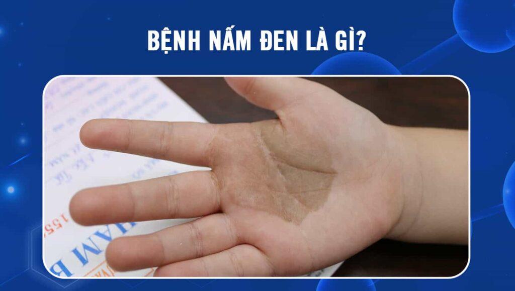 Bệnh nấm đen