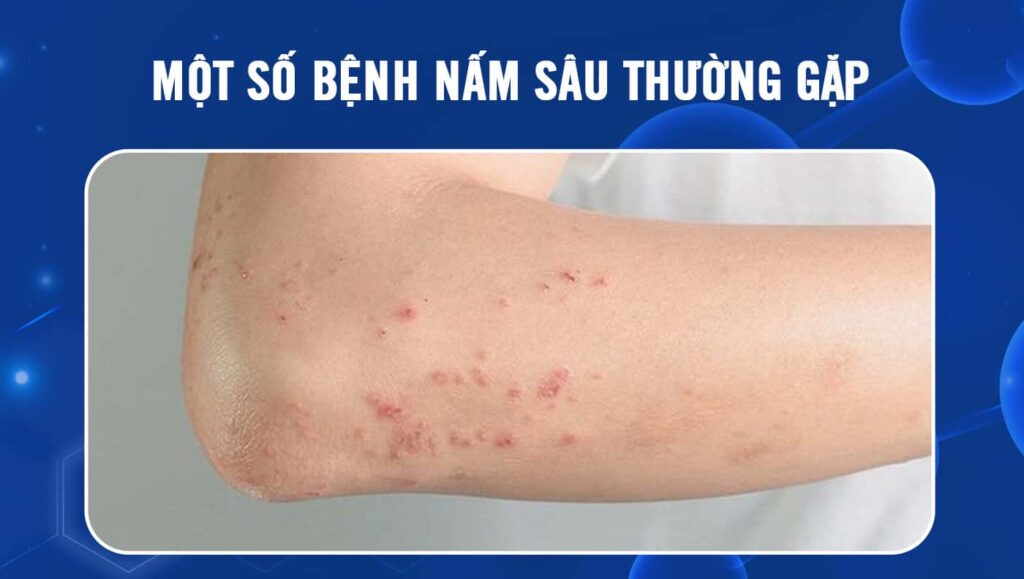 bệnh nấm sâu
