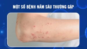 bệnh nấm sâu