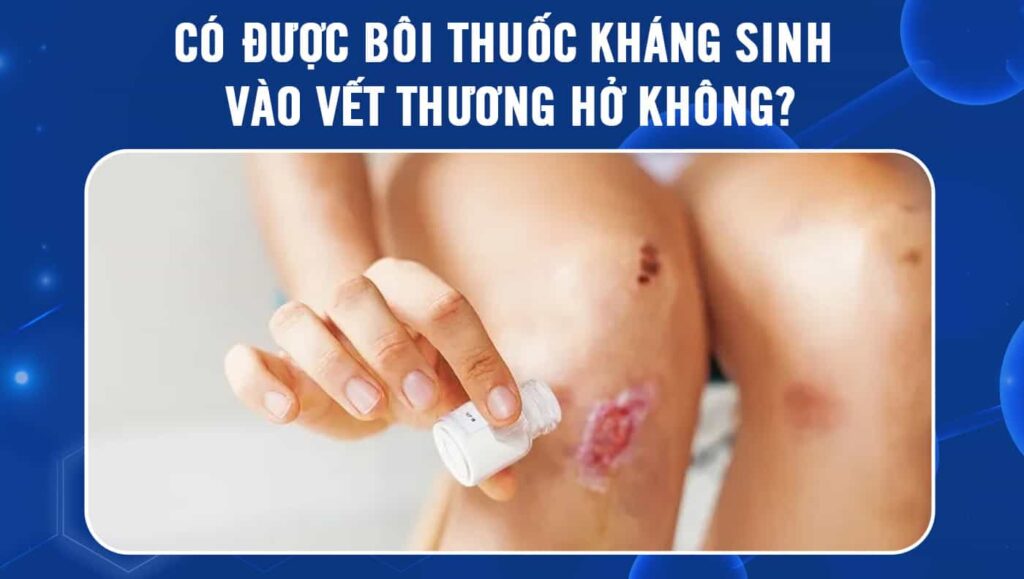 bôi thuốc kháng sinh vào vết thương hở