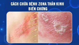 cách chữa bệnh zona thần kinh biến chứng