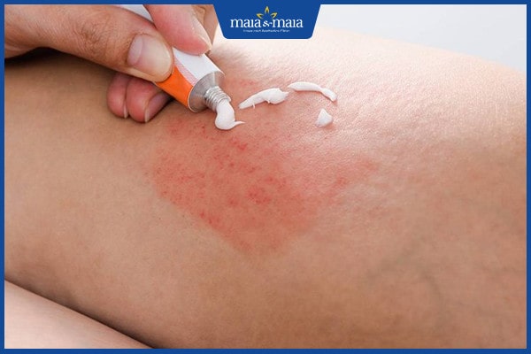cách giảm ngứa khi bị viêm da cơ địa