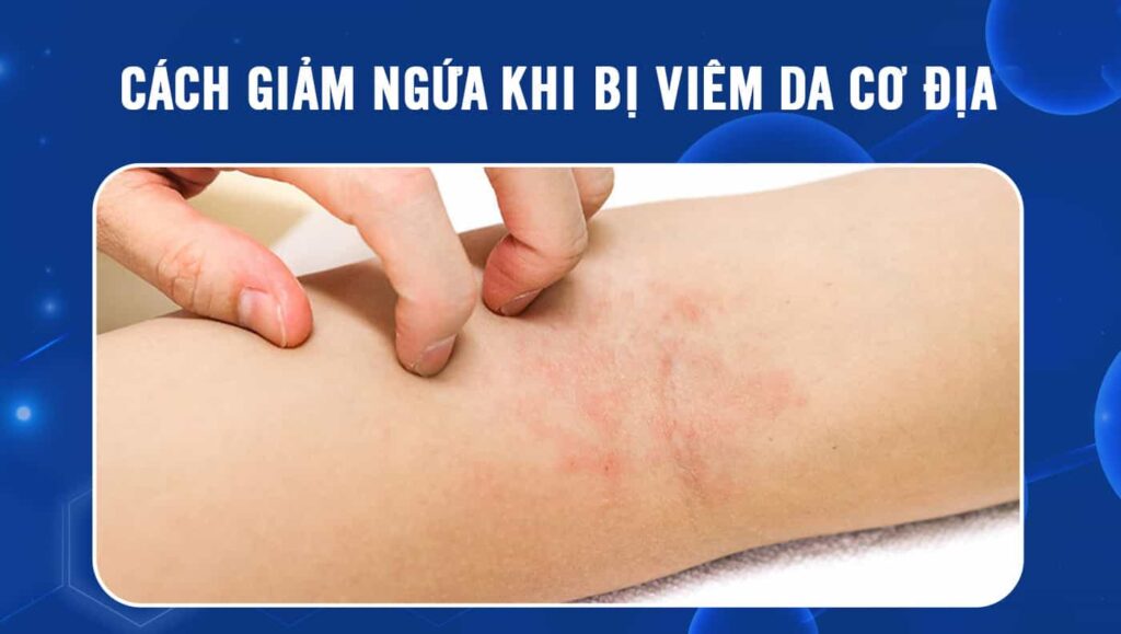 cách giảm ngứa khi bị viêm da cơ địa
