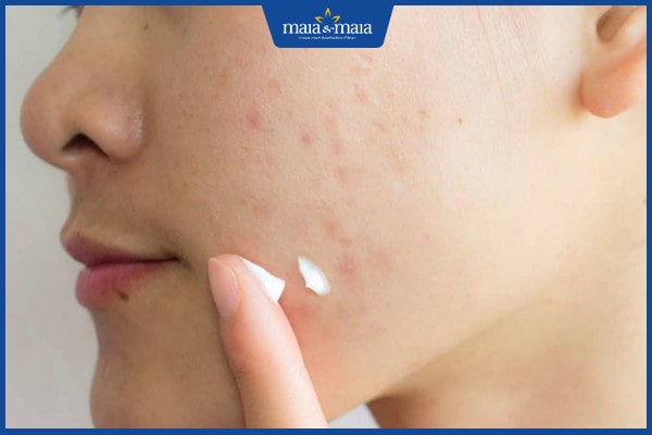 chăm sóc da sau nặn mụn