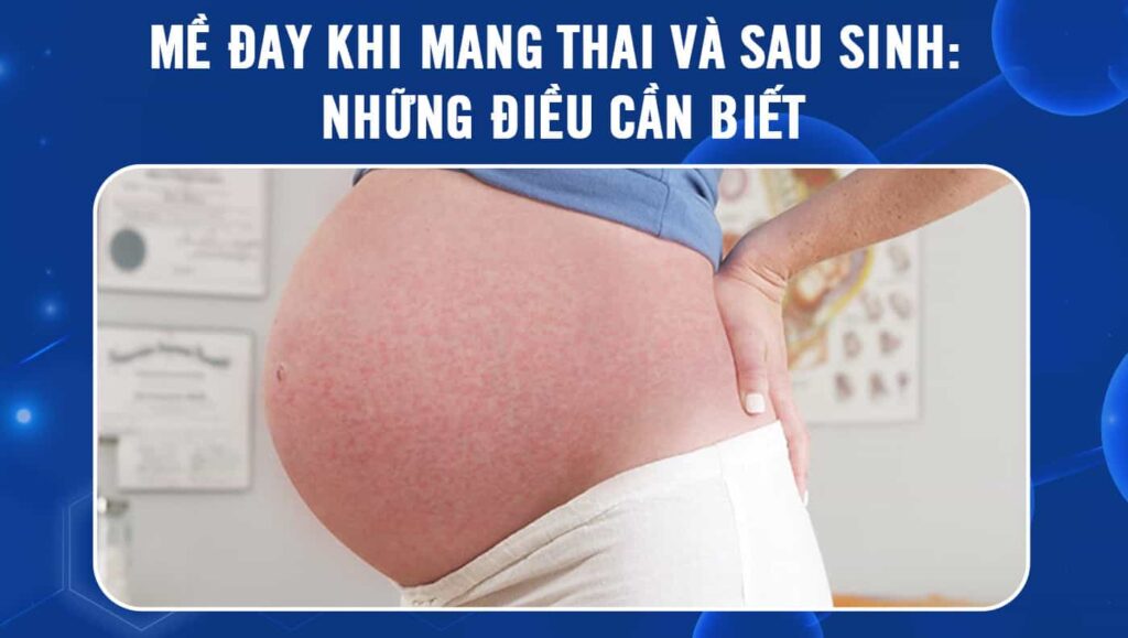 mề đay khi mang thai và sau sinh