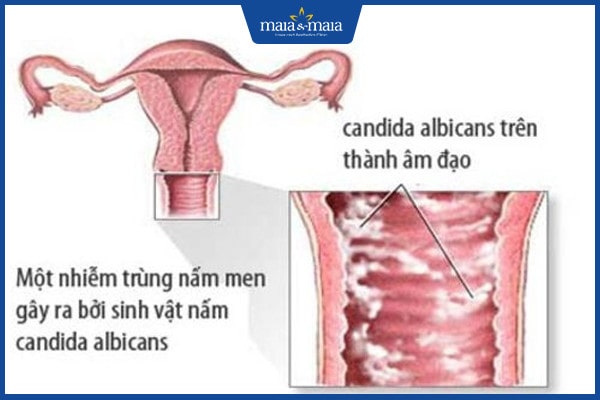 nhiễm nấm có nghiêm trọng không