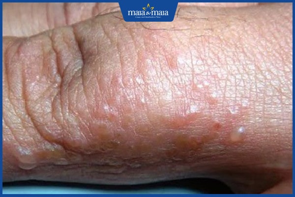 nhiễm nấm có nghiêm trọng không