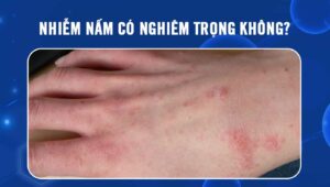 nhiễm nấm có nghiêm trọng không