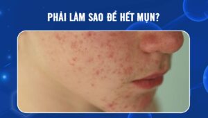 Phải làm sao để hết mụn