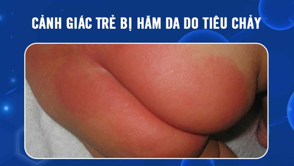 hăm da do tiêu chảy