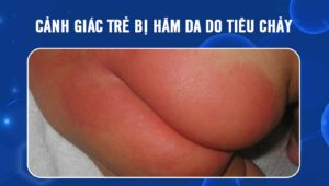 hăm da do tiêu chảy