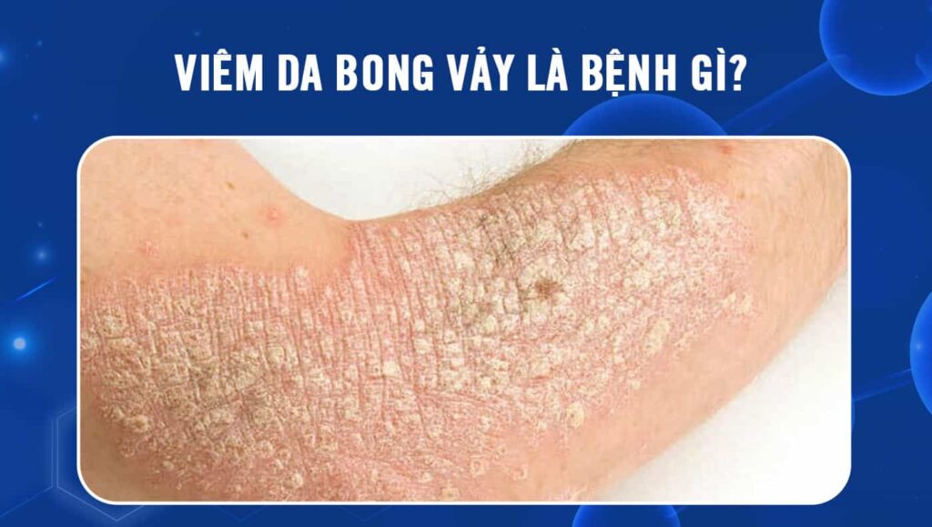 viêm da bong vảy