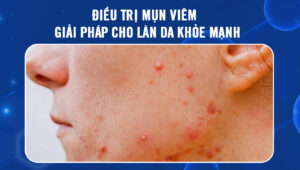 dieu-tri-mun-viem
