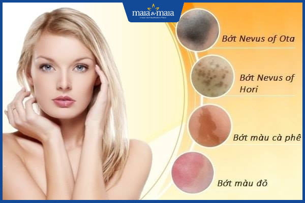 Điều trị chàm bớt bằng công nghệ Laser Toning có hiệu quả như lời đồn