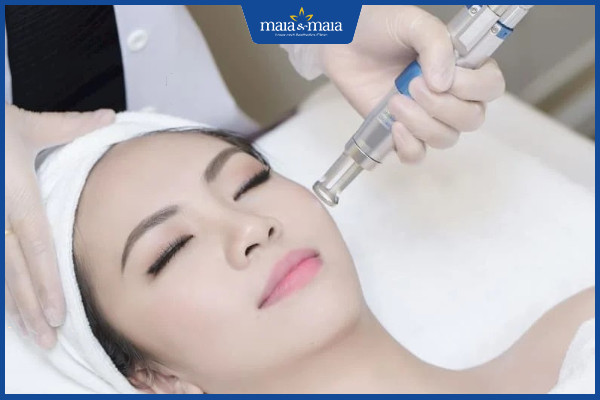 Điều trị chàm bớt bằng công nghệ Laser Toning có hiệu quả như lời đồn