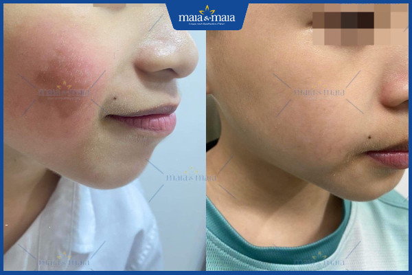 Điều trị chàm bớt bằng công nghệ Laser Toning có hiệu quả như lời đồn