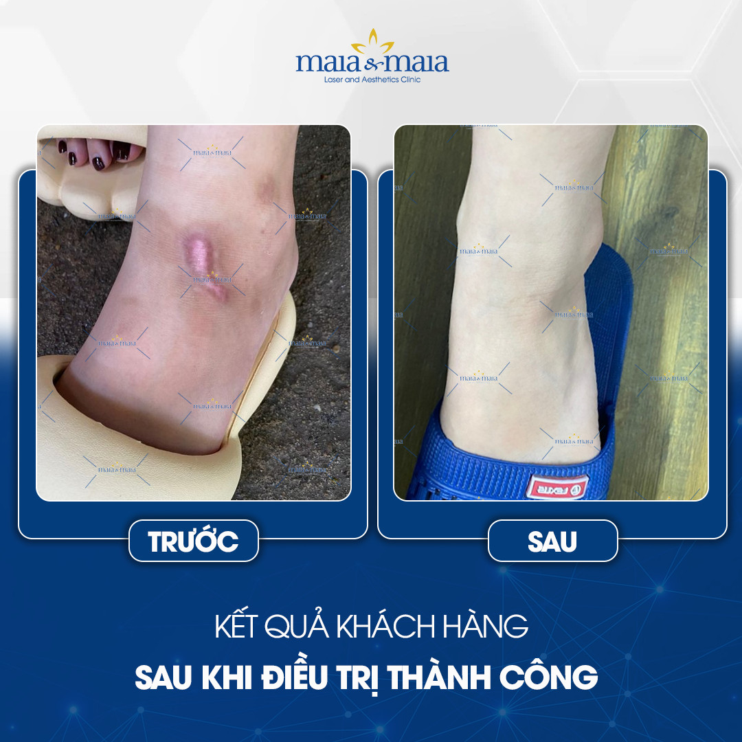 phuong-phap-dieu-tri-seo-9