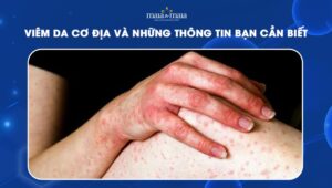 [TỔNG HỢP] Viêm da cơ địa và những thông tin bạn cần biết