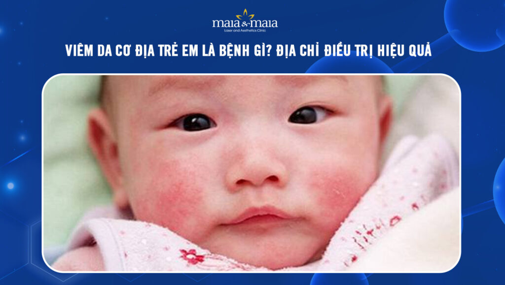 Viêm da cơ địa trẻ em là bệnh gì? Địa chỉ điều trị hiệu quả