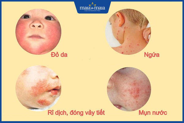 Viêm da cơ địa trẻ em là bệnh gì? Địa chỉ điều trị hiệu quả