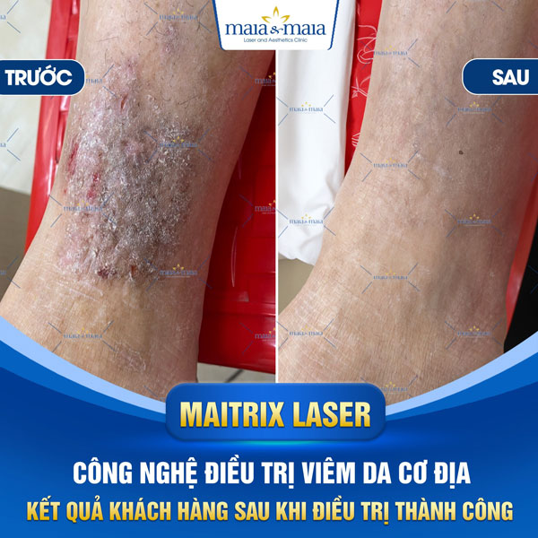 trị viêm da chân