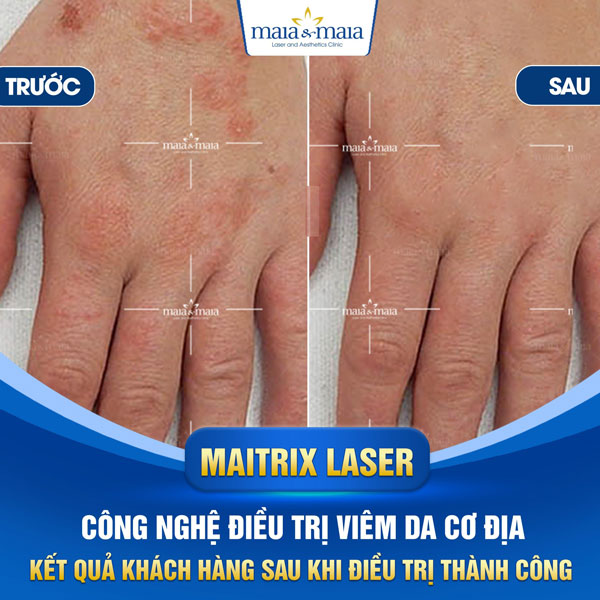 trị viêm da tay